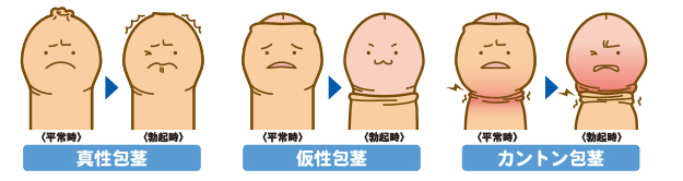 包茎の種類