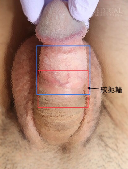 カントン包茎、裏筋(小帯)を残した症例解説