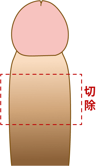 包茎手術の料金トラブル　パート1