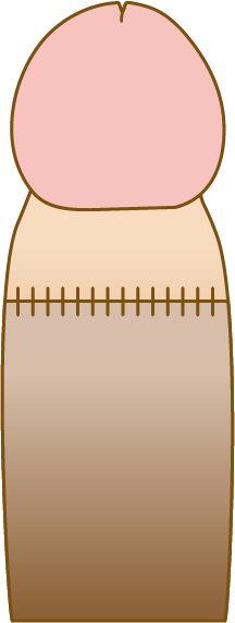 包茎手術の料金トラブル　パート1