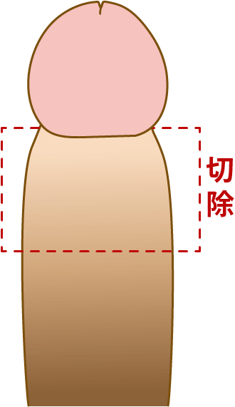 包茎手術の料金トラブル　パート1