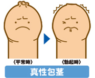 真性包茎