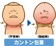 カントン包茎