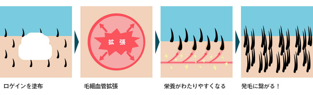 ロゲインフォームを塗布 毛細血管拡張 栄養がわたりやすくなる 発毛に繋がる！