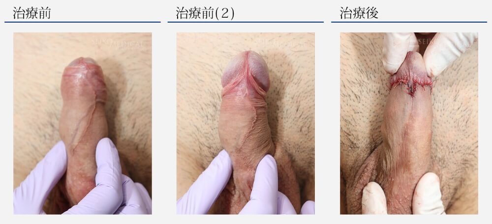 カントン包茎治療