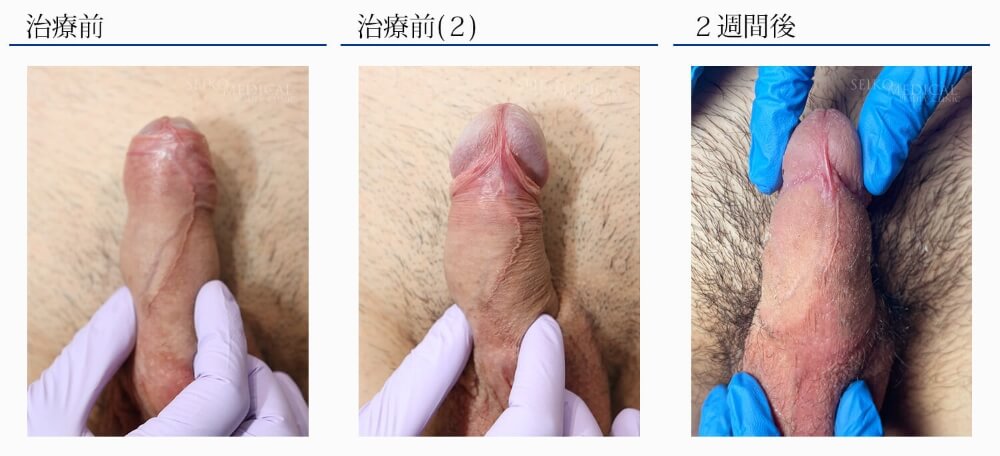 カントン包茎治療