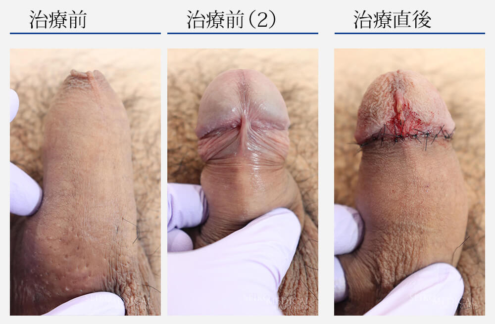 カントン包茎治療