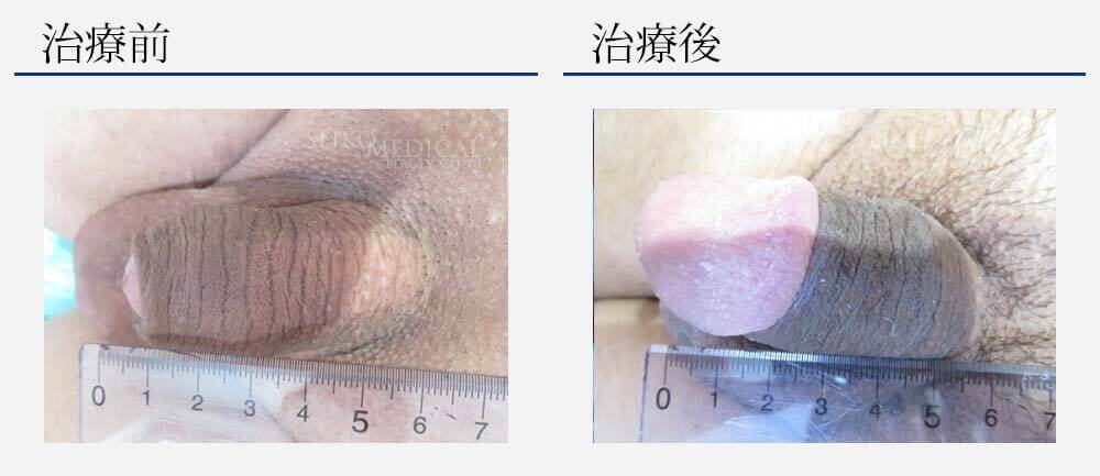 仮性包茎治療
