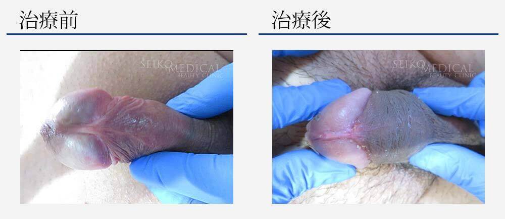 仮性包茎治療