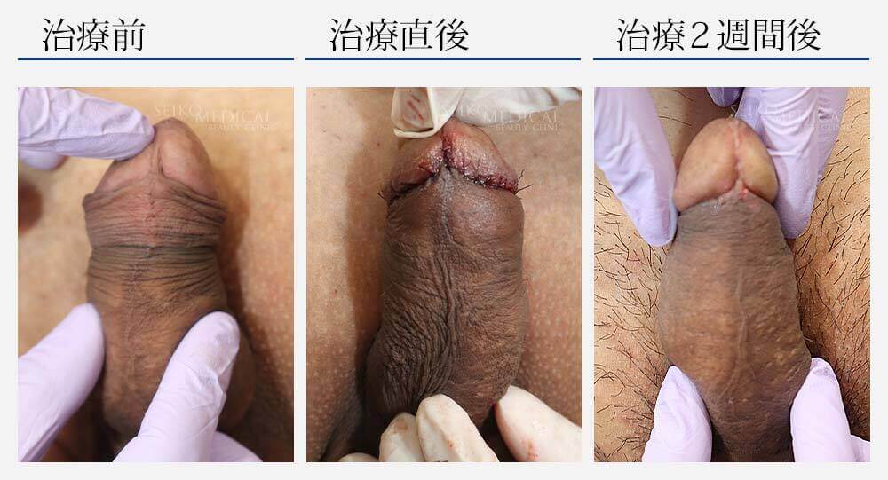 仮性包茎治療