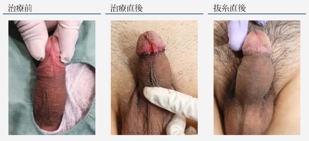 仮性包茎治療