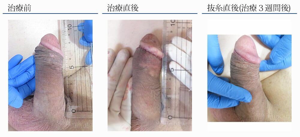 仮性包茎治療 リパスG注入