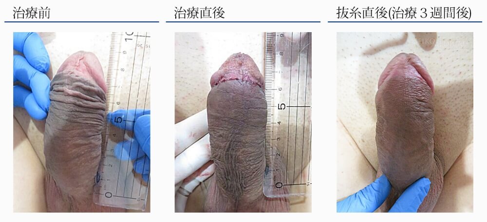 仮性包茎治療 リパスG注入