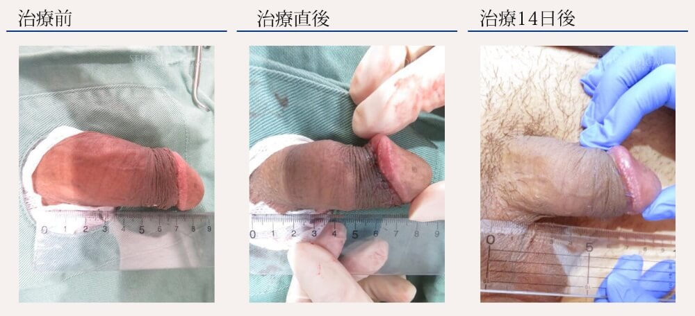 仮性包茎治療 リパスG