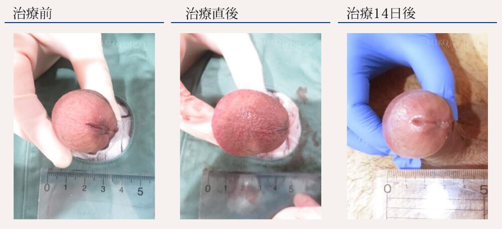 仮性包茎治療 リパスG