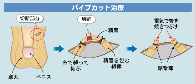 パイプカット手術の方法