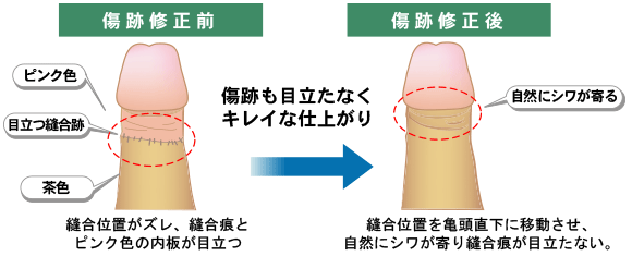 茎治療後のツートンカラー修正
